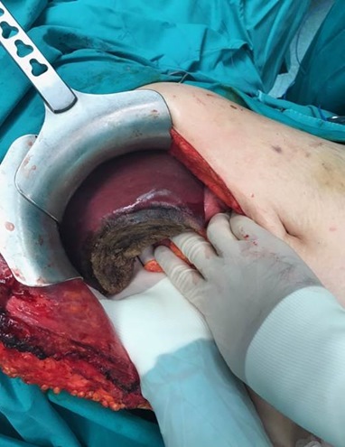 liver segmentectomy for metastatic lesion