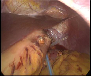 laparoskopiki-periferiki-pagkreaktomi