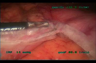 sleeve-gastrectomy2